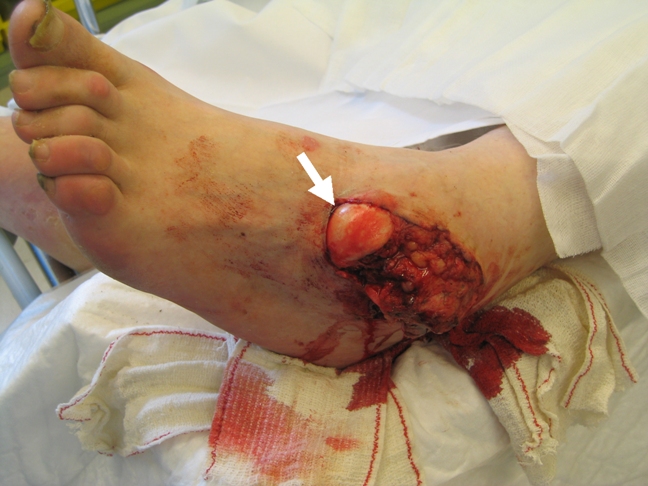 Figure 1: The high energy forced inversion of the foot causes talus dislocation leaving the talar head exposed (arrow).